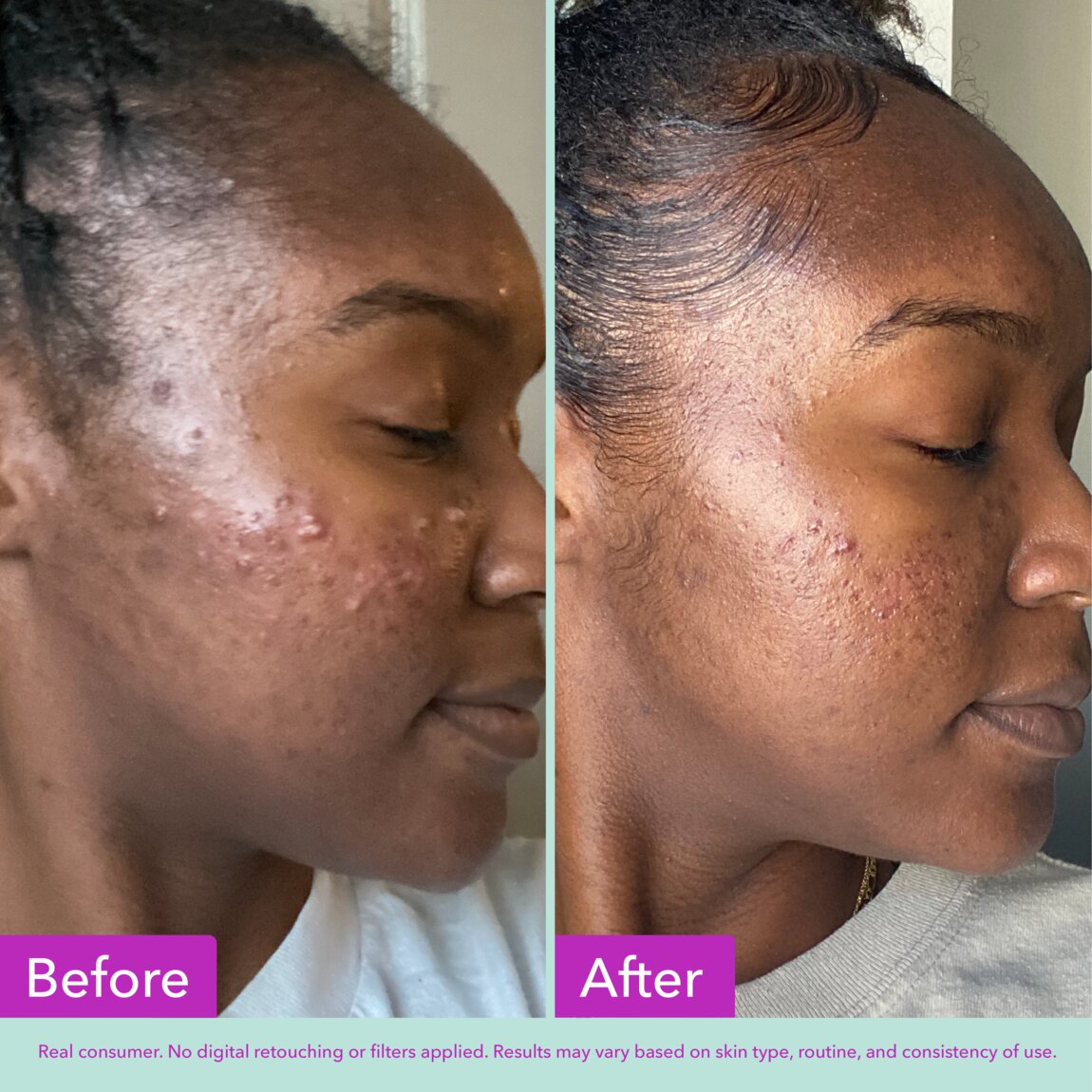 acne-foaming-cleanser-f1 zb_p.jpg
