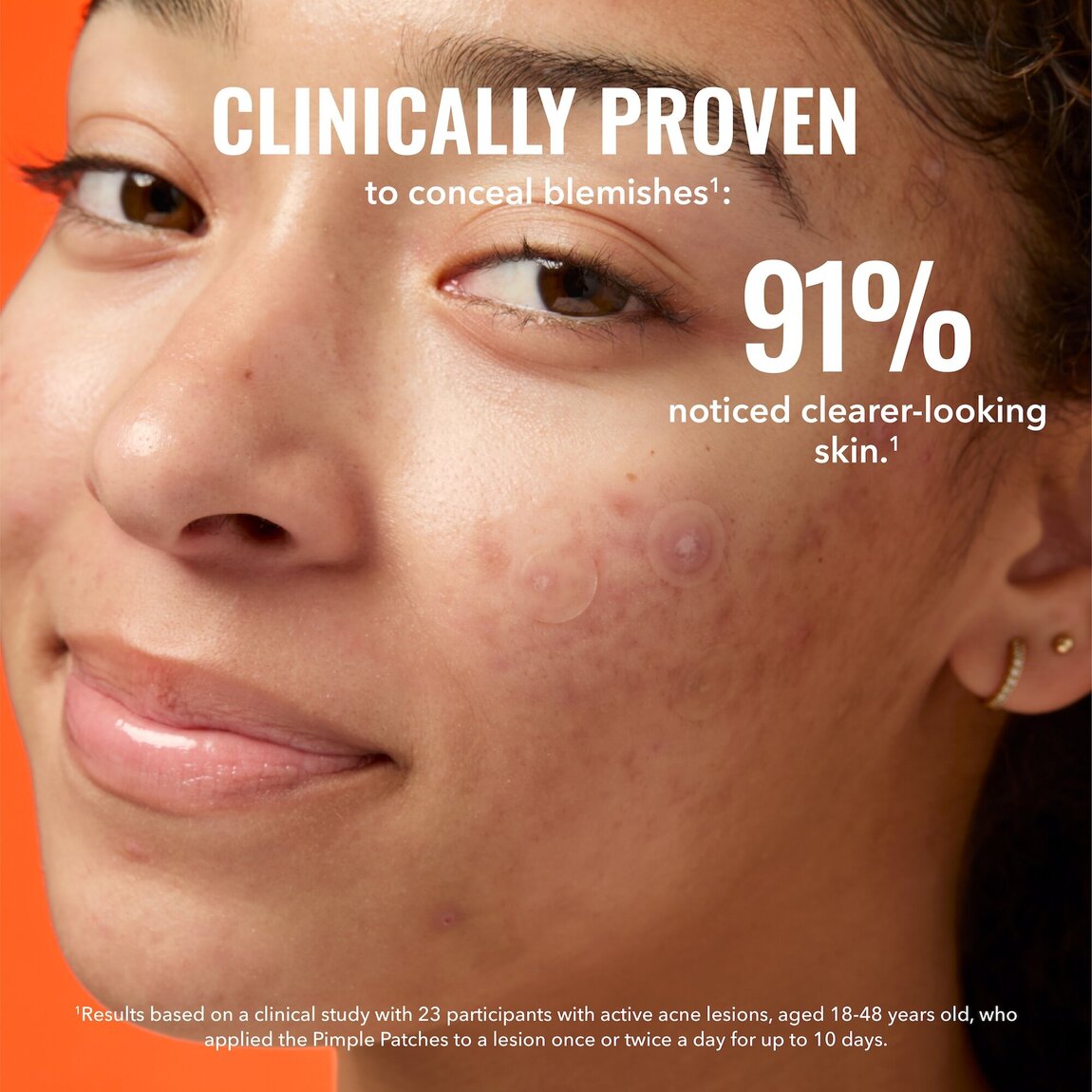 pimple-patches-k8 zb_p.jpg